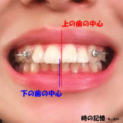 交叉咬合-前歯の中心のズレ