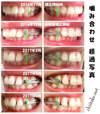 カリエールディスタライザーとゴムかけでの非抜歯矯正-噛み合せの変化 201611-201706
