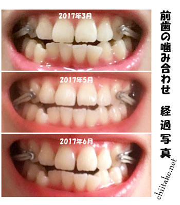 カリエールディスタライザーとゴムかけでの非抜歯矯正-前歯の噛み合せの変化 201611-201706