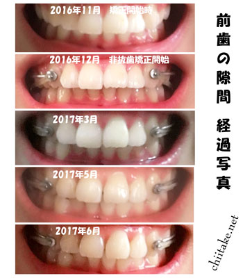 カリエールディスタライザーとゴムかけでの非抜歯矯正-前歯の隙間 201611-201706