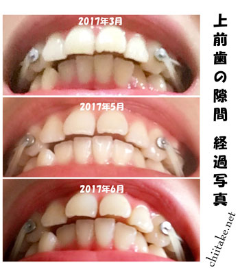 カリエールディスタライザーとゴムかけでの非抜歯矯正-下から見た上前歯の隙間 201611-201706