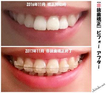 表側装置(セラミックブラケット)での非抜歯矯正ビフォーアフター-上前歯 201611-201711