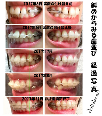 表側装置(セラミックブラケット)での非抜歯矯正-斜めから見る歯並び 201706-201711