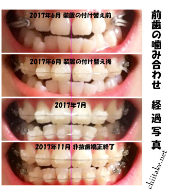 表側装置(セラミックブラケット)での非抜歯矯正-斜めから見る前歯の噛み合わせと正中のズレ 201706-201711