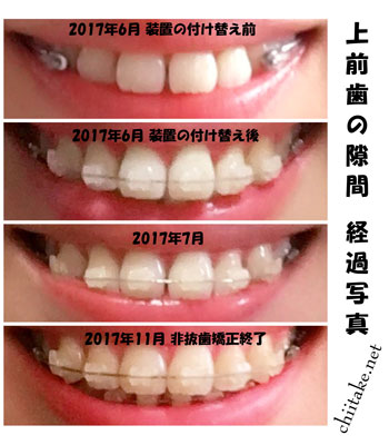表側装置(セラミックブラケット)での非抜歯矯正-上前歯の隙間 201706-201711