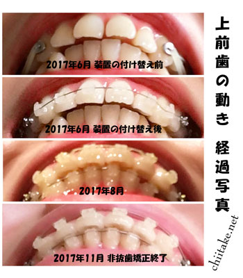 表側装置(セラミックブラケット)での非抜歯矯正-上前歯の動き 201706-201711