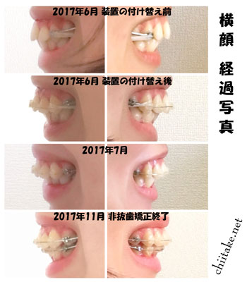 表側装置(セラミックブラケット)での非抜歯矯正-横顔 201706-201711
