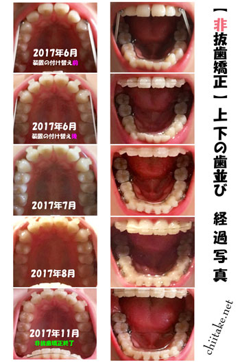 表側装置(セラミックブラケット)での非抜歯矯正-上下の歯並びの変化 201706-201711