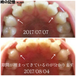 下から見た歯の隙間 2017-02