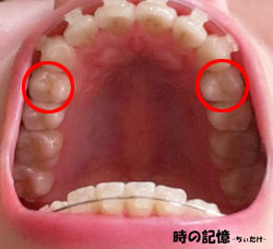 上の第一小臼歯
