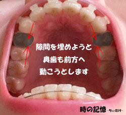 歯の動く仕組み-抜歯後