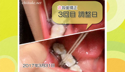 カリエールディスタライザーとゴムかけによる非抜歯矯正調整日 20170331