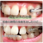 前歯の隙間の虫歯治療 20170519