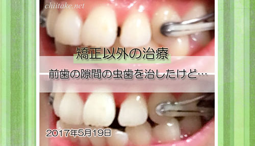 前歯の隙間の虫歯治療 20170519