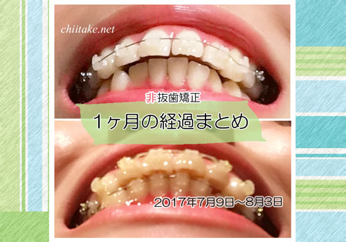 矯正経過写真 上の歯と下の歯の距離間が縮まる 7月9日 8月3日 比較 出っ歯の非抜歯 抜歯矯正ブログ