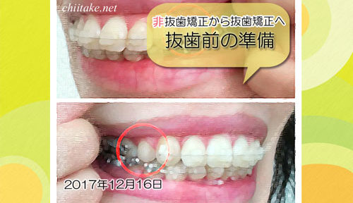 非抜歯矯正から抜歯矯正前の準備 20171216
