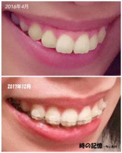 斜め上から見た出っ歯の変化 201801-04