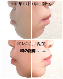 出っ歯の横顔の変化 201801
