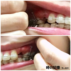 上の歯の歯列矯正用アンカースクリューとブラケット装置 201801