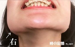 下顎のアンカースクリュー埋入後の頬の腫れ 201802-02