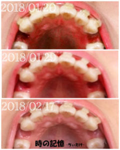 抜歯後から1回目調整日までの下から見た歯の動き 201802