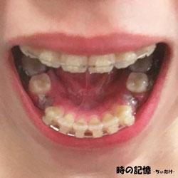抜歯後の白い血餅 201802-01