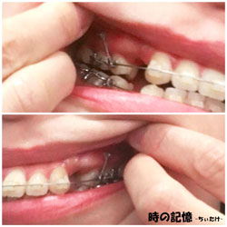 上の歯の歯列矯正用アンカースクリューとブラケット装置 201803