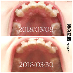 抜歯矯正-1ヵ月での歯の動き-下から見た上の歯 201803