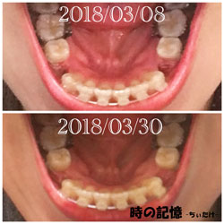抜歯矯正-1ヵ月での歯の動き-上から見た下の歯 201803