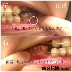 下顎に打った歯科矯正用アンカースクリューが歯茎に埋もれる-03