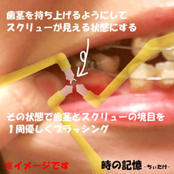 下顎に打った歯科矯正用アンカースクリューが歯茎に埋もれた場合のブラッシング方法