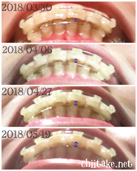 抜歯矯正-1ヵ月での歯の動き-下から見た噛み合わせ 201805