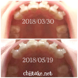 抜歯矯正-1ヵ月での歯の動き-下から見た上の歯 201805