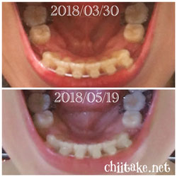 抜歯矯正-1ヵ月での歯の動き-上から見た下の歯 201805