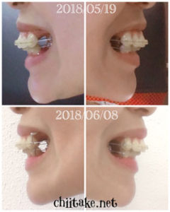 抜歯矯正-1ヵ月での歯の動き-横顔 2018060