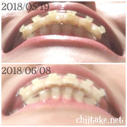 抜歯矯正-1ヵ月での歯の動き-下から見た噛み合わせ 201806