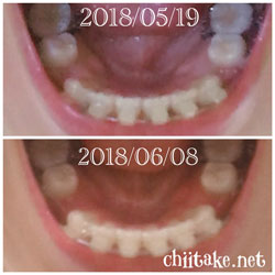 抜歯矯正-1ヵ月での歯の動き-上から見た下の歯 201806