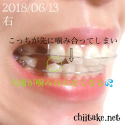 犬歯が噛み合わない 201806-01