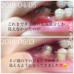 右下顎に打った歯科矯正用アンカースクリューの様子 201806-01