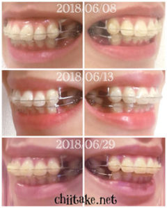 抜歯矯正-1ヵ月での歯の動き-犬歯の位置 201806