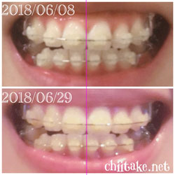 抜歯矯正-1ヵ月での歯の動き-正中 201806
