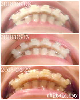 抜歯矯正-1ヵ月での歯の動き-上下の歯の距離感 201806