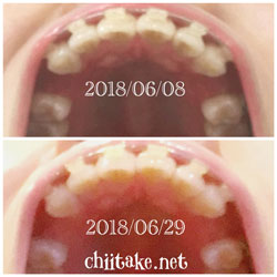 抜歯矯正-1ヵ月での歯の動き-下から見た上の歯 201806