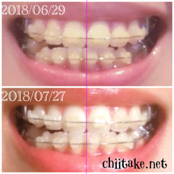 抜歯矯正-1ヵ月での歯の動き-正中 201807