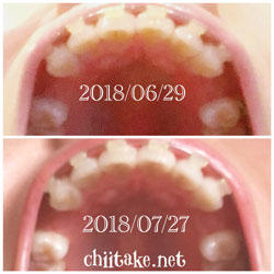 抜歯矯正-1ヵ月での歯の動き-下から見る上の歯 201807