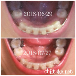 抜歯矯正-1ヵ月での歯の動き-上から見る下の歯 201807