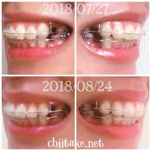 抜歯矯正-1ヵ月での歯の動き-犬歯の位置 201808