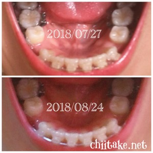 抜歯矯正-1ヵ月での歯の動き-上から見る下の歯 201808