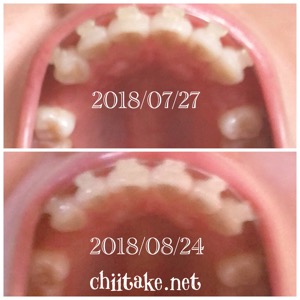 抜歯矯正-1ヵ月での歯の動き-下から見る上の歯 201808
