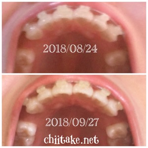 インプラント矯正-1ヵ月での歯の動き-下から見る上の歯 201809